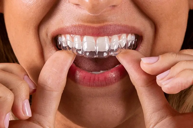 Representación de alineadores dentales invisibles