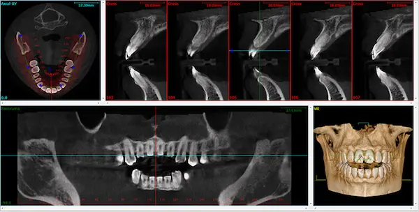 Tomógrafos dentales mostrando imágenes 3D de estructuras maxilofaciales en diferentes vistas para diagnóstico.