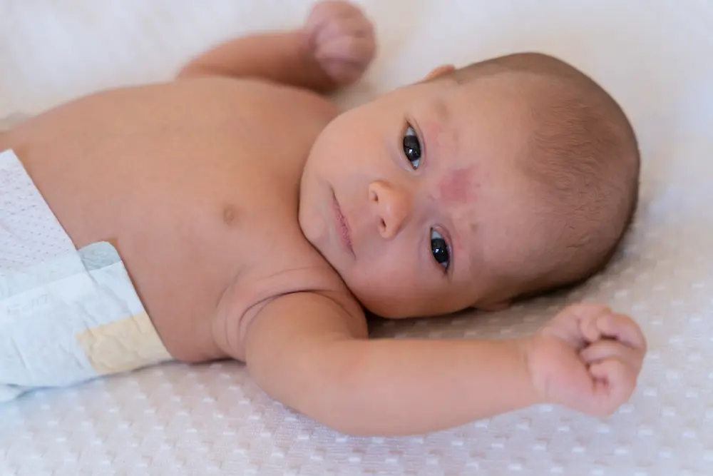 Cómo diagnosticar la piel atópica en bebés