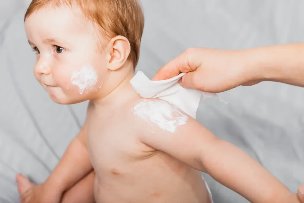 Piel atópica en bebés causas, síntomas y cuidados esenciales