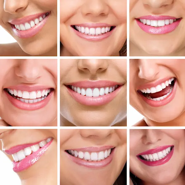 Tratamiento de estética dental para mejorar la sonrisa