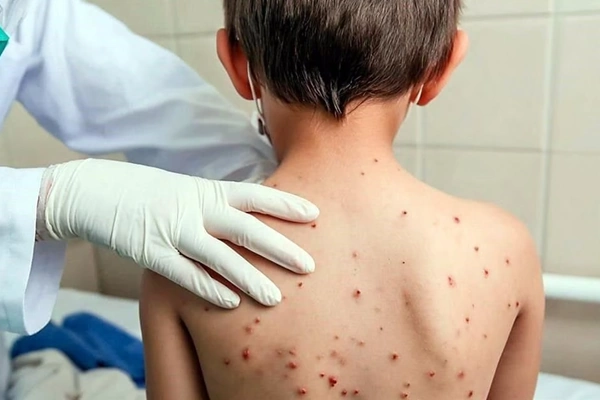Emergencia sanitaria por brote de sarampión en Perú 2026