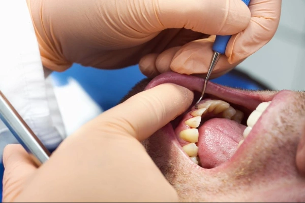 Síntomas de la gingivitis