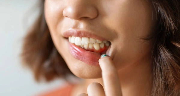 Tratamientos y cuidado profesional para la gingivitis