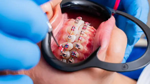 BENEFICIOS DE UNA ENDODONCIA