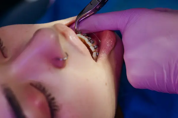 ¿QUE ES UNA ENDODONCIA?
